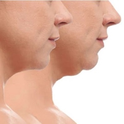 hifu treatments at wiles studios northampton hifu treatments at wiles studios northampton