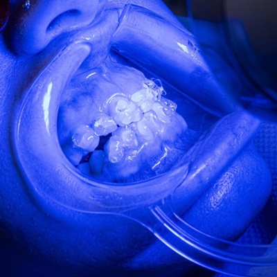 teeth whitening at wiles studios in northampton teeth whitening at wiles studios in northampton